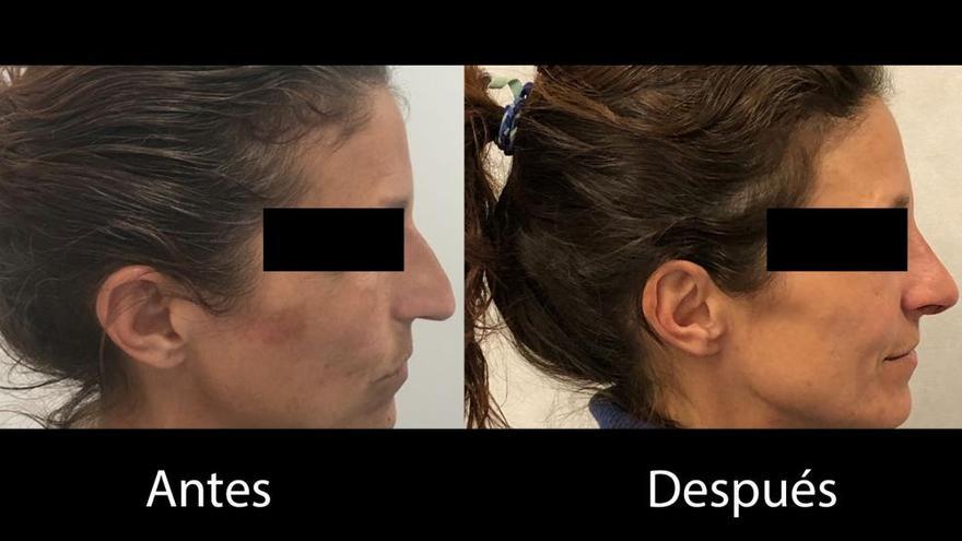 Rinoplastia: una nariz bonita y funcional