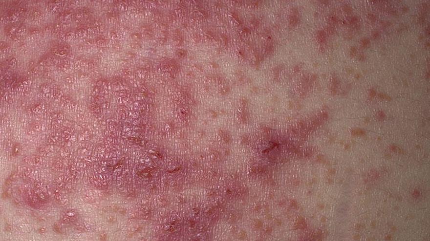 Cuidado de la piel: La dermatitis atópica