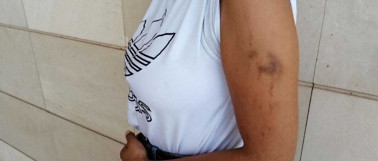 La madre detenida muestra los hematomas y arañazos que tiene en el brazo.