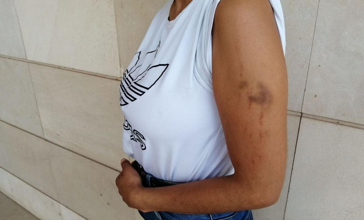 La madre detenida muestra los hematomas y arañazos que tiene en el brazo.