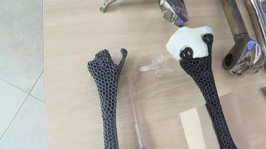 Así es la primera prótesis ósea personalizada de metamaterial del mundo, diseñada en el Hospital Gregorio Marañón de Madrid