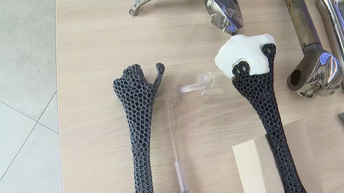 El Gregorio Marañón, primer hospital del mundo en fabricar e implantar una prótesis ósea de metamaterial personalizada