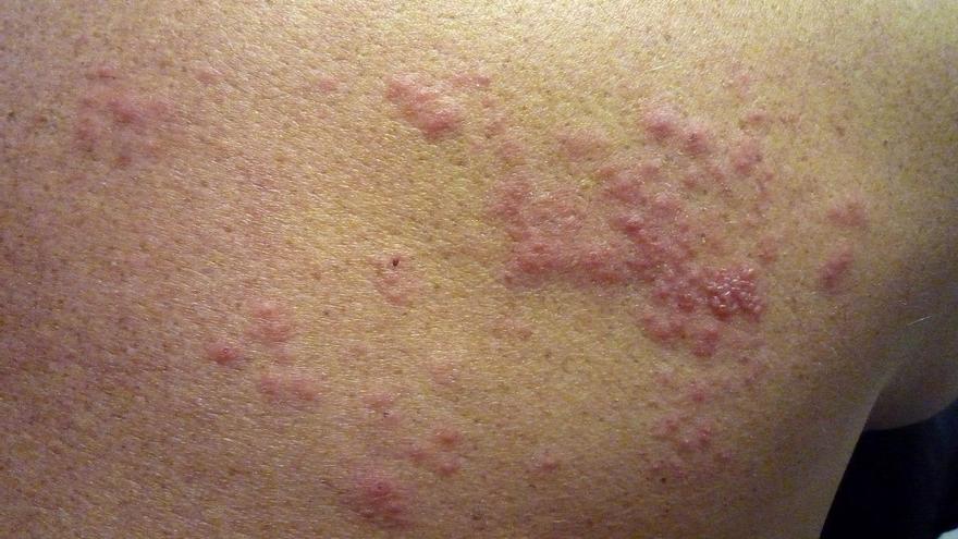 Augmenten els casos d’herpes zòster: què és, símptomes i qui s’ha de vacunar