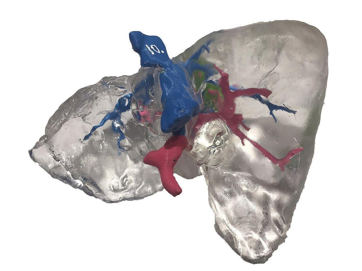 Modelo carcinoma de hígado en 3D.