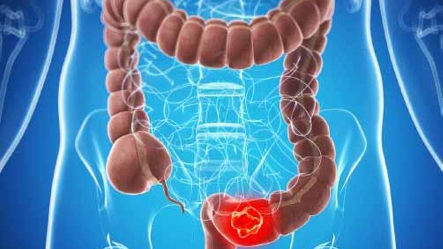 Más de 900 casos nuevos de cáncer colorrectal cada año