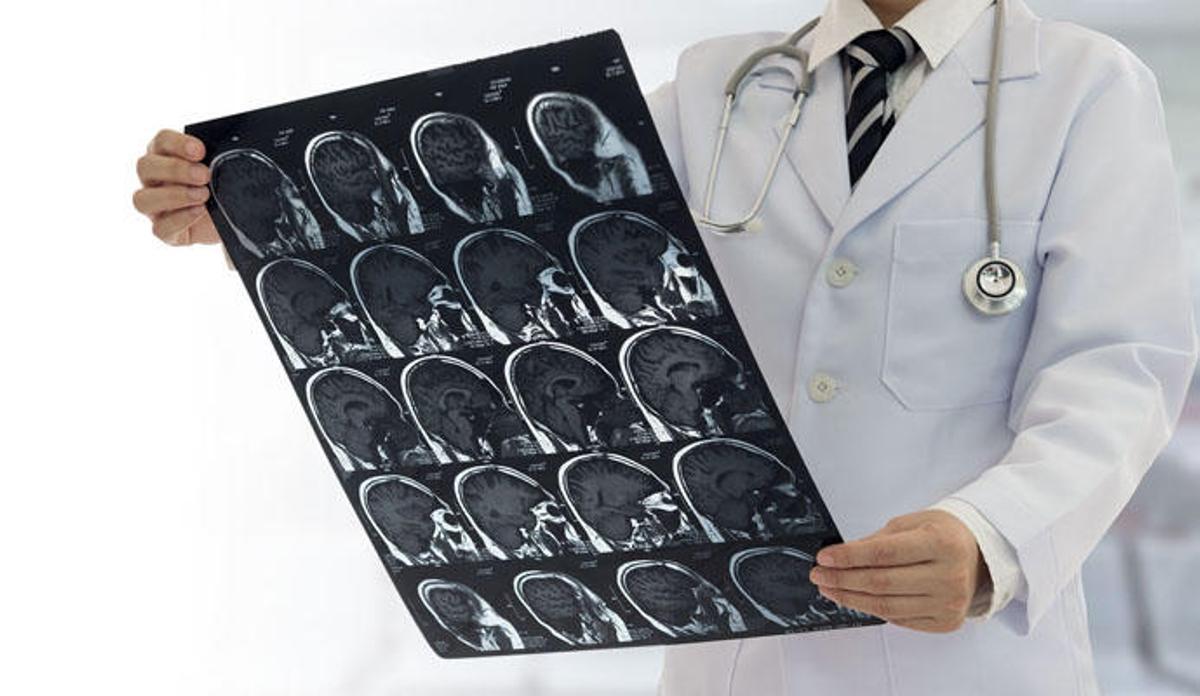 La medicació que pot ajudar a moltes persones contra l'ictus