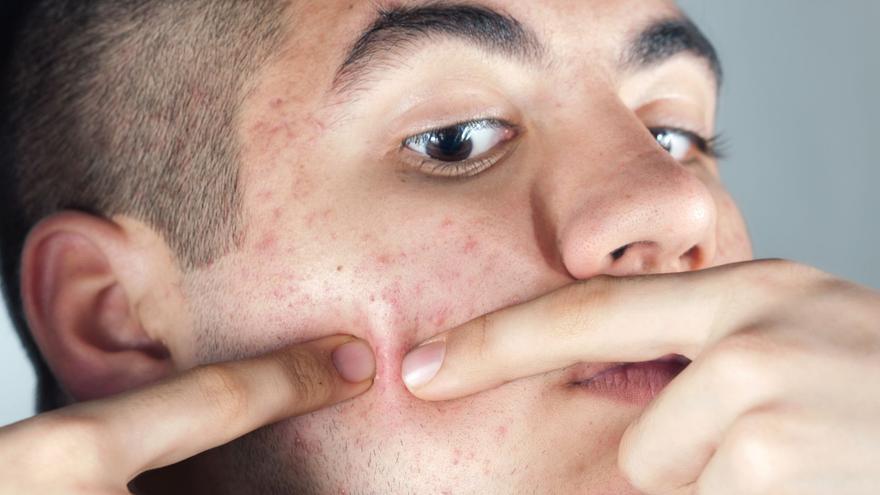 La seria advertencia de un farmacéutico: &quot;Si te aprietas un grano de la cara te puedes morir&quot;