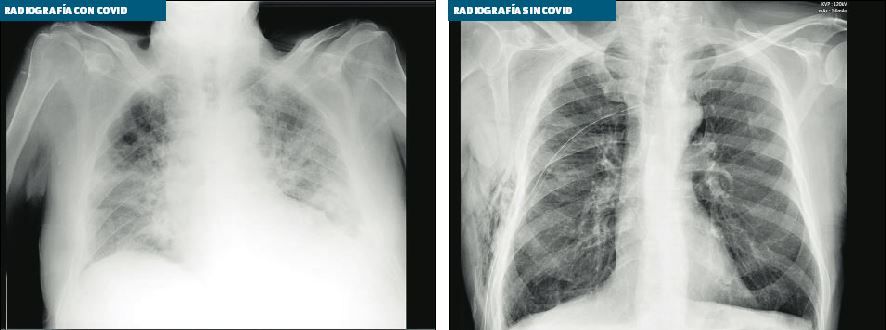 Investigadores usarán la inteligencia artificial para detectar covid en radiografías