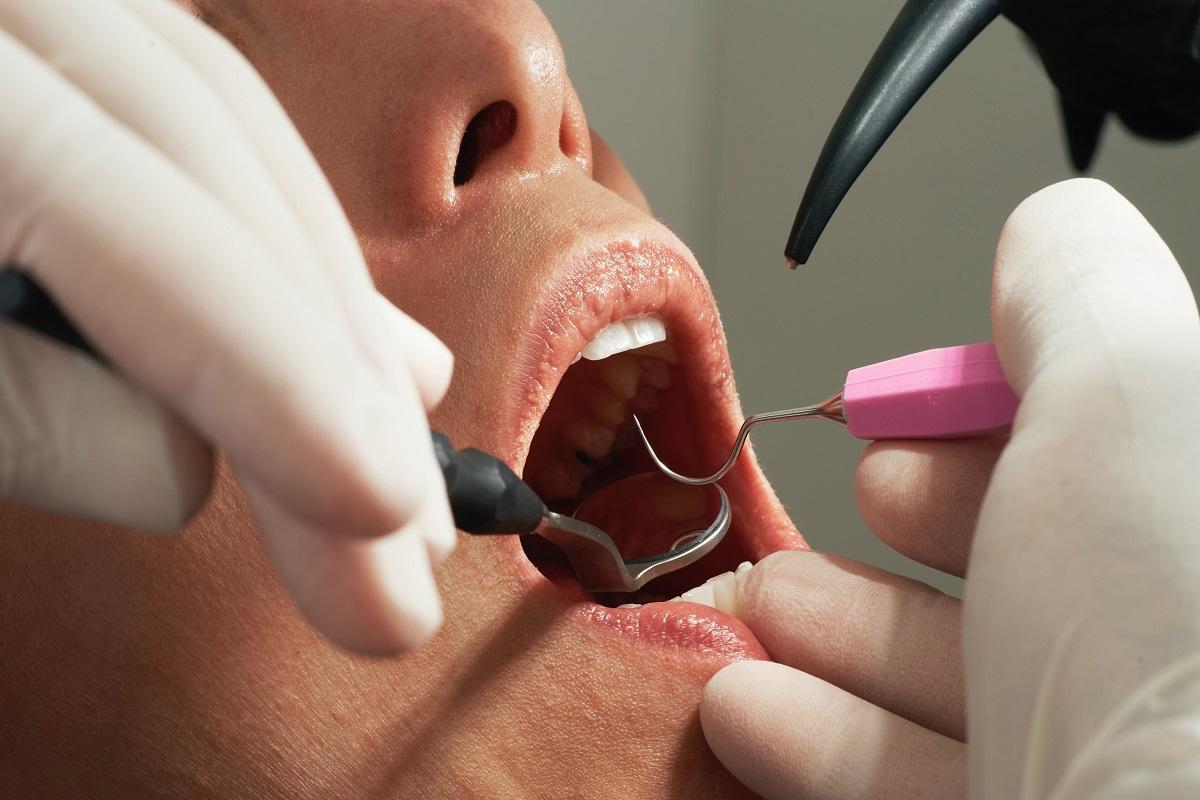Tener diabetes puede incrementar el riesgo de problemas periodontales.
